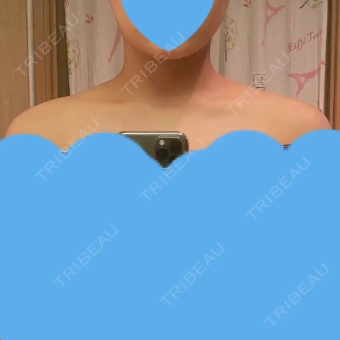 ボトックス（エラ・小顔） / ボトックス（肩） TCB東京中央美容外科 川口院 DAY 1 メイン用