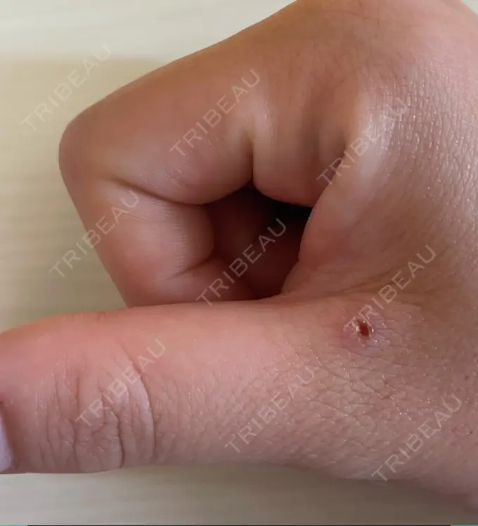 ほくろ・いぼ切除（肌） 吉祥寺アイビークリニック DAY 4 メイン用