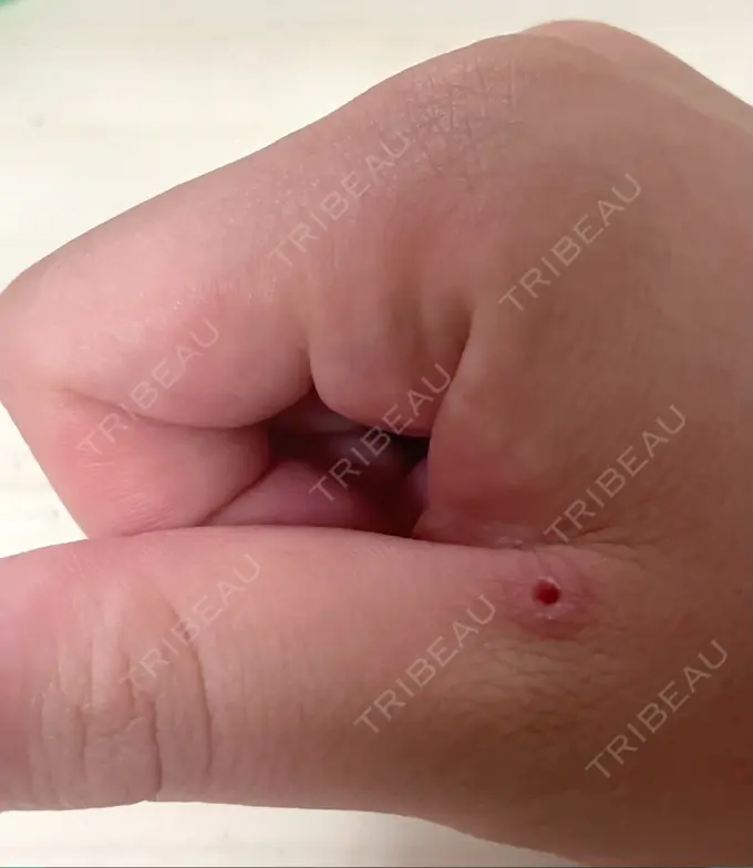 ほくろ・いぼ切除（肌） 吉祥寺アイビークリニック DAY 5 メイン用