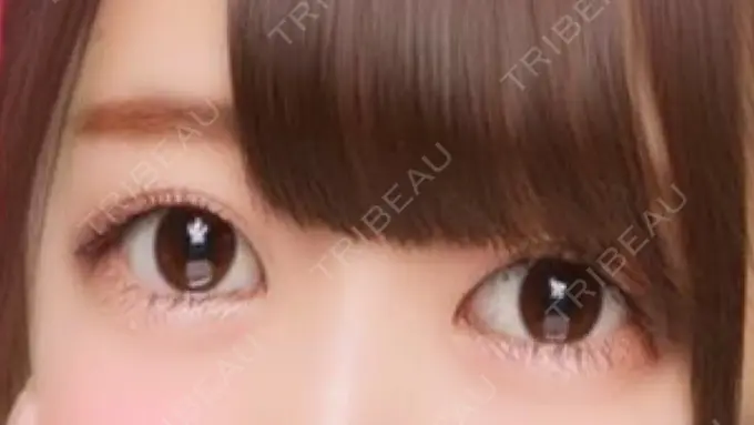 二重埋没 品川スキンクリニック広島院 AFTER メイン用