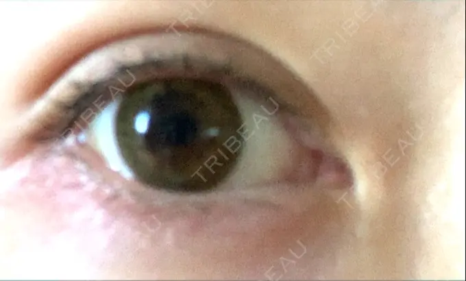 二重埋没 十仁美容整形 DAY 4 メイン用