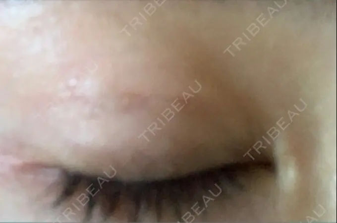 二重埋没 十仁美容整形 DAY 4 メイン用