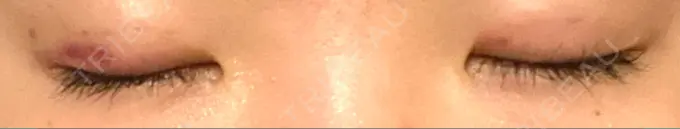 二重埋没 大塚美容形成外科 金沢院 DAY 7 メイン用