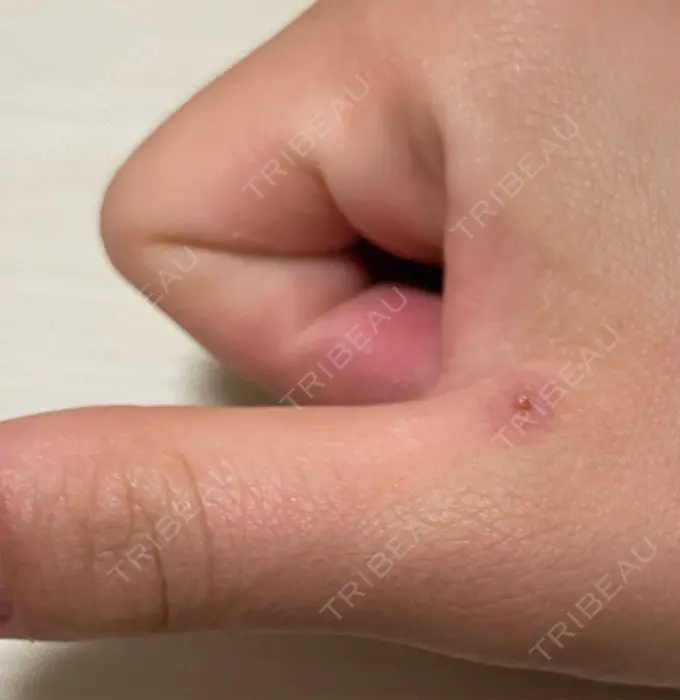 ほくろ・いぼ切除（肌） 吉祥寺アイビークリニック DAY 6 メイン用