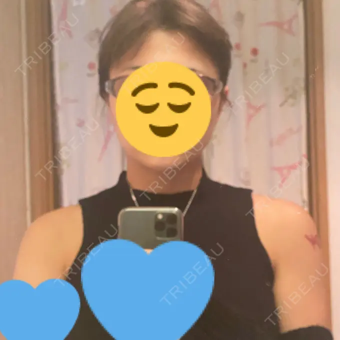 ボトックス（エラ・小顔） / ボトックス（肩） TCB東京中央美容外科 川口院 DAY 2 メイン用