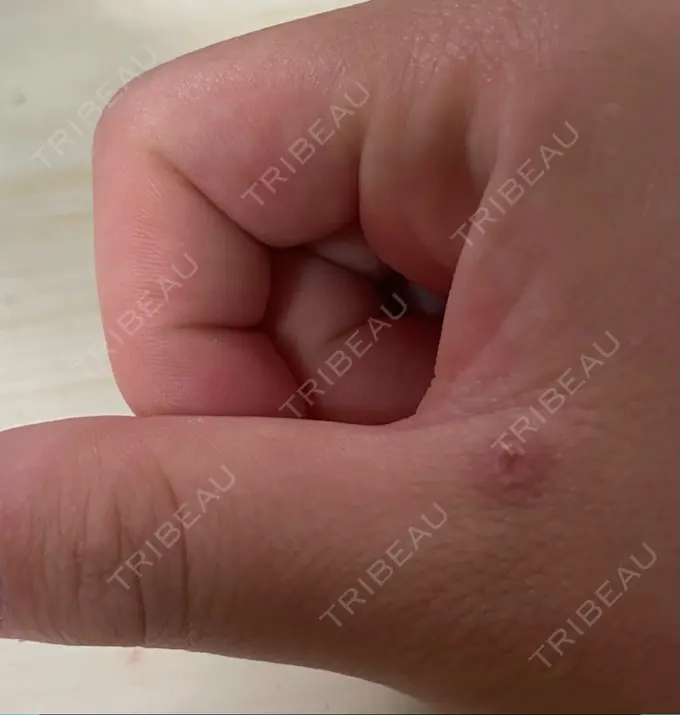 ほくろ・いぼ切除（肌） 吉祥寺アイビークリニック DAY 7 メイン用