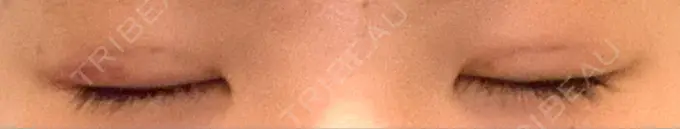 二重埋没 大塚美容形成外科 金沢院 AFTER メイン用