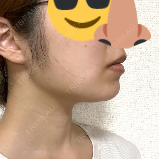 糸リフト / 脂肪吸引（顔） 東京シンデレラ美容外科 池袋院 DAY 11 メイン用