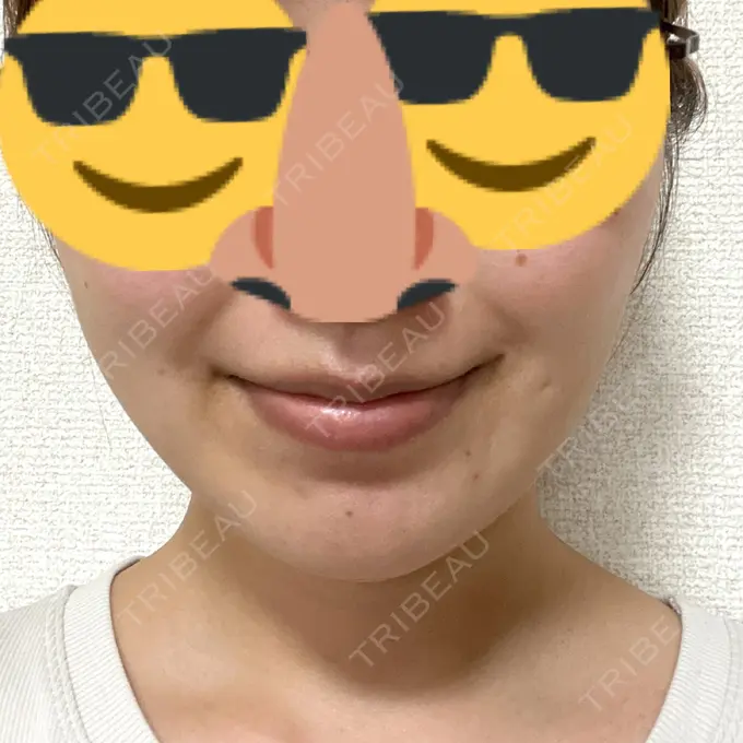 糸リフト / 脂肪吸引（顔） 東京シンデレラ美容外科 池袋院 DAY 11 メイン用