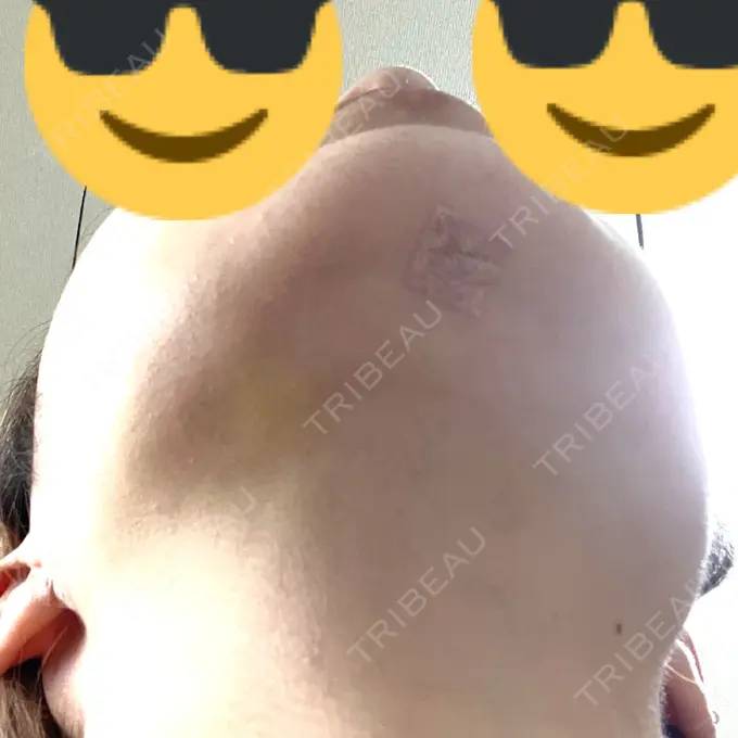 糸リフト / 脂肪吸引（顔） 東京シンデレラ美容外科 池袋院 DAY 11 メイン用