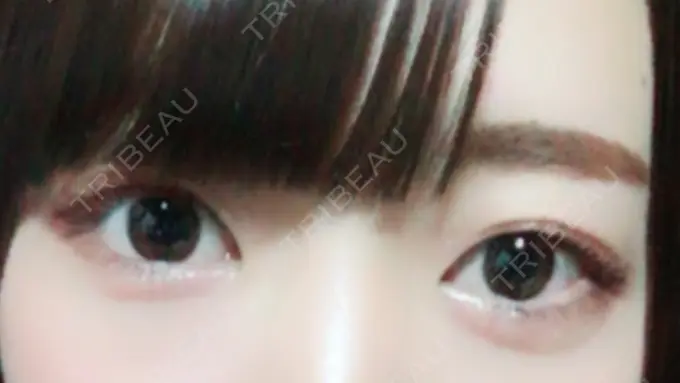 二重埋没 品川スキンクリニック広島院 DAY 362 メイン用