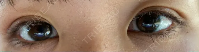 二重埋没 アマソラクリニック DAY 6 メイン用