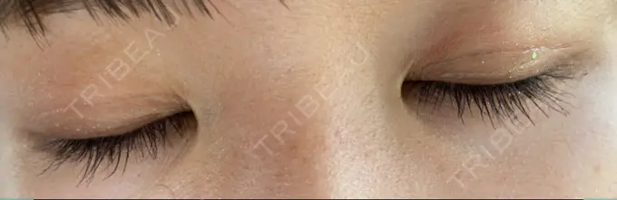 二重埋没 アマソラクリニック DAY 6 メイン用