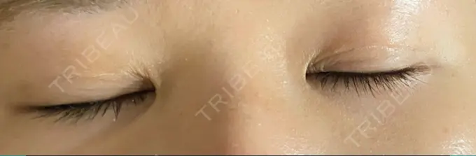 二重埋没 アマソラクリニック DAY 7 メイン用