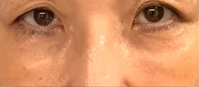 クマ治療 / 下まぶたたるみ取り / 脂肪注入（肌） 湘南美容クリニック 藤沢院 DAY 11 メイン用