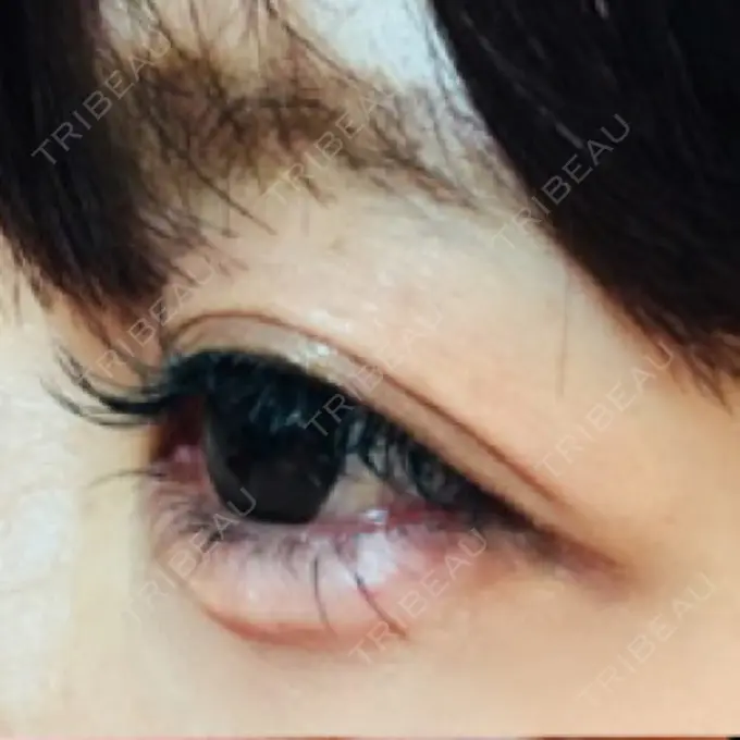 ヒアルロン酸注入（涙袋） 衣理クリニック表参道 AFTER メイン用