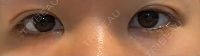 二重埋没 アマソラクリニック DAY 8 メイン用