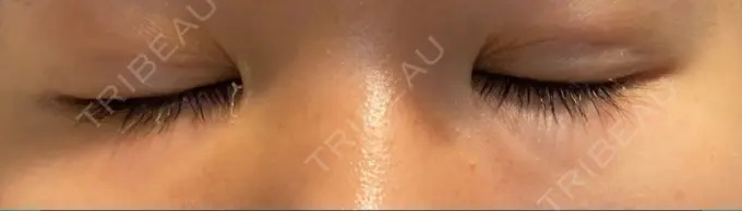 二重埋没 アマソラクリニック DAY 8 メイン用