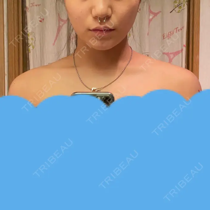 ボトックス（エラ・小顔） / ボトックス（肩） TCB東京中央美容外科 川口院 DAY 4 メイン用