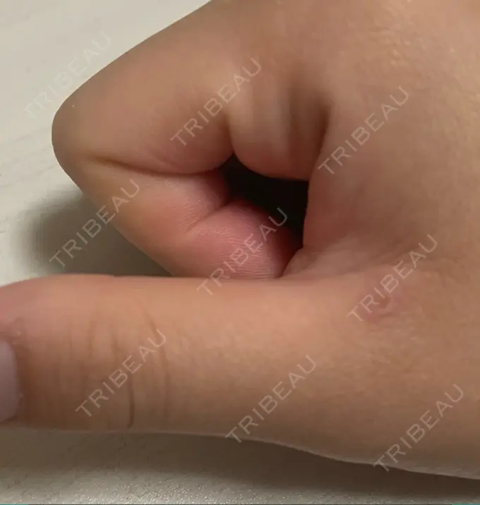 ほくろ・いぼ切除（肌） 吉祥寺アイビークリニック DAY 8 メイン用