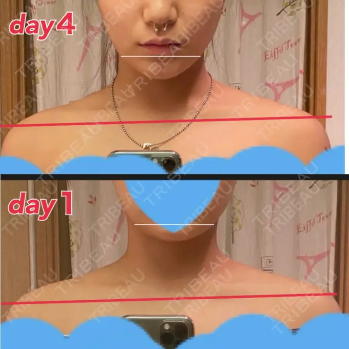 ボトックス（エラ・小顔） / ボトックス（肩） TCB東京中央美容外科 川口院 AFTER メイン用