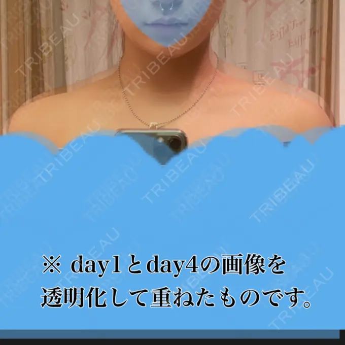 ボトックス（エラ・小顔） / ボトックス（肩） TCB東京中央美容外科 川口院 DAY 5 メイン用