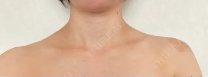 ボトックス（肩） BRIGHTS beauty clinic AFTER メイン用