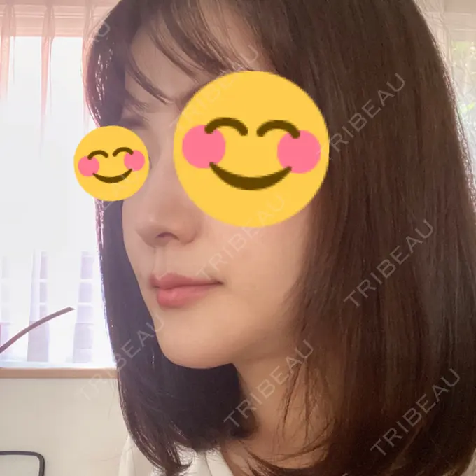 骨切り（あご） / 骨削り（エラ） / セットバック / その他（輪郭） アーククリニック DAY 132 メイン用