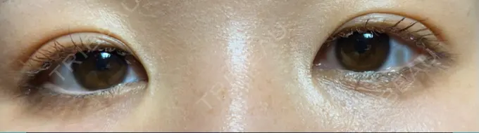 二重埋没 アマソラクリニック DAY 9 メイン用