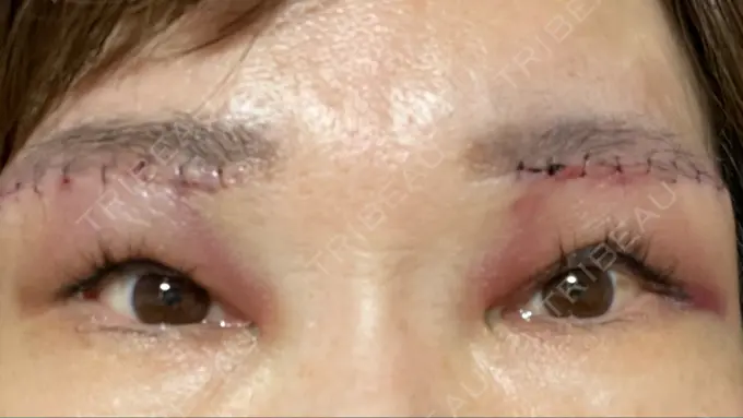 上まぶたたるみ取り 心斎橋形成外科スキンケアクリニック DAY 1 メイン用