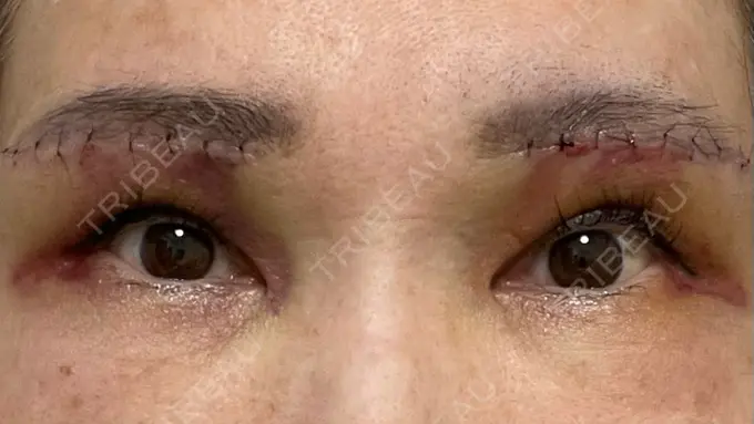 上まぶたたるみ取り 心斎橋形成外科スキンケアクリニック DAY 2 メイン用