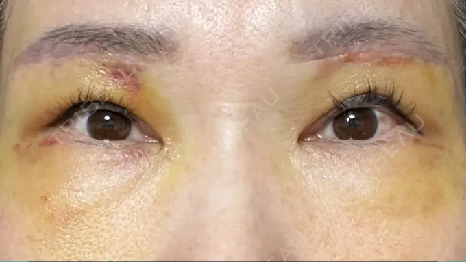 上まぶたたるみ取り 心斎橋形成外科スキンケアクリニック DAY 6 メイン用