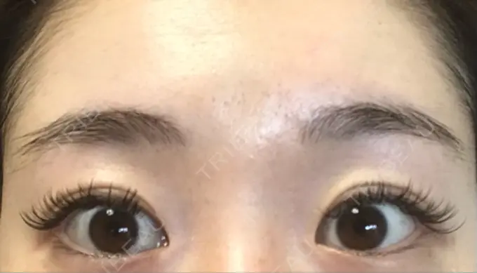 二重切開 有楽町高野美容クリニック DAY 212 メイン用