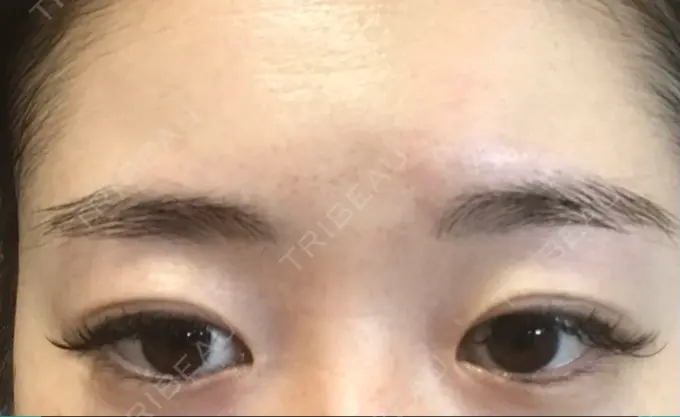 二重切開 有楽町高野美容クリニック DAY 212 メイン用