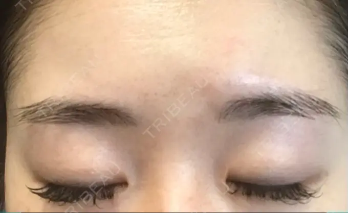 二重切開 有楽町高野美容クリニック DAY 212 メイン用