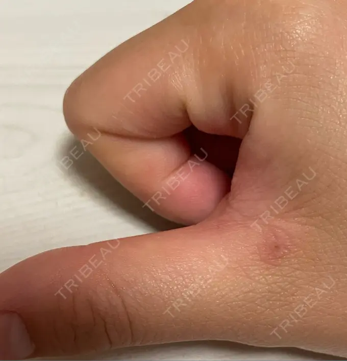 ほくろ・いぼ切除（肌） 吉祥寺アイビークリニック DAY 10 メイン用