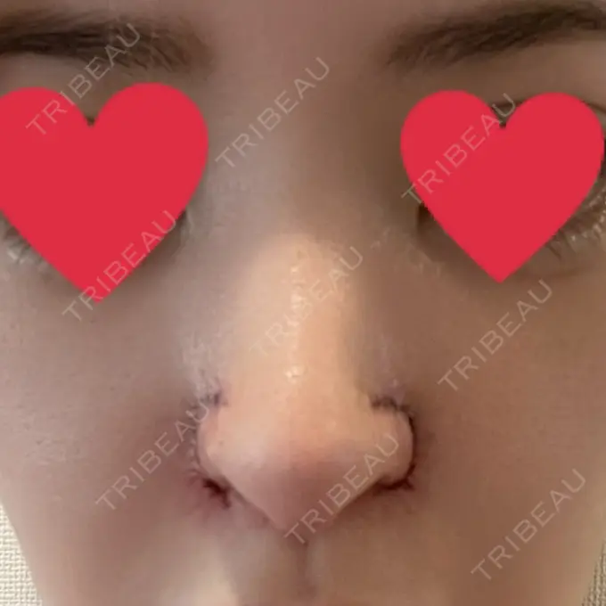 鼻中隔延長（切開） / 小鼻縮小（切開） / 脂肪吸引（お腹） / 軟骨移植 / 骨切幅寄せ / 鼻修正 / 鼻尖縮小 / 鼻翼基部形成（貴族手術） ヴェリテクリニック 大阪院 DAY 15 メイン用