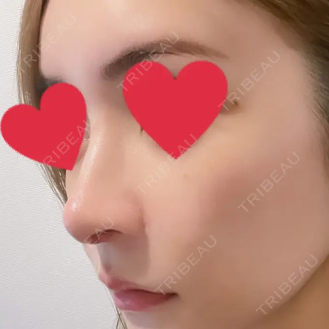 鼻中隔延長（切開） / 小鼻縮小（切開） / 脂肪吸引（お腹） / 軟骨移植 / 骨切幅寄せ / 鼻修正 / 鼻尖縮小 / 鼻翼基部形成（貴族手術） ヴェリテクリニック 大阪院 DAY 15 メイン用