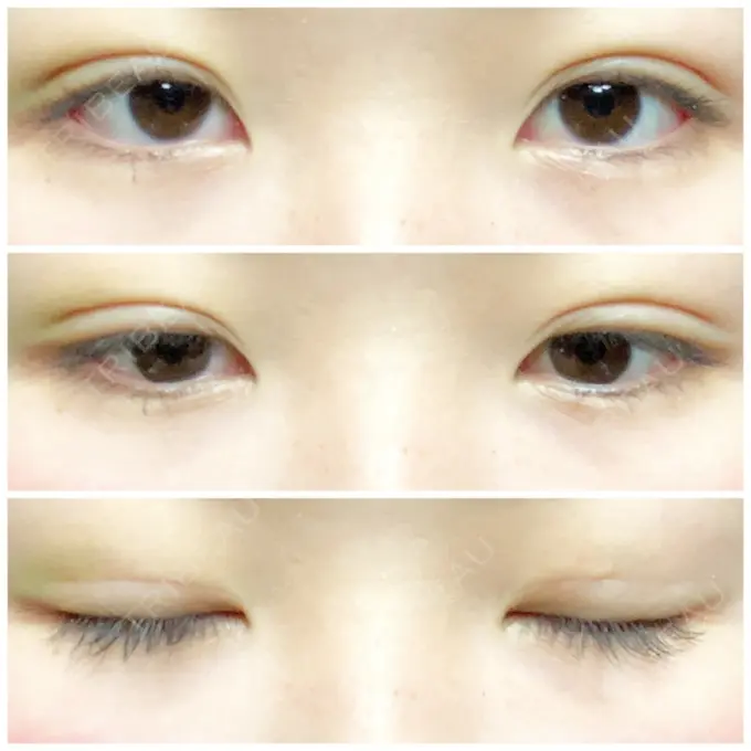 二重埋没 湘南美容クリニック 長野院 DAY 6 メイン用