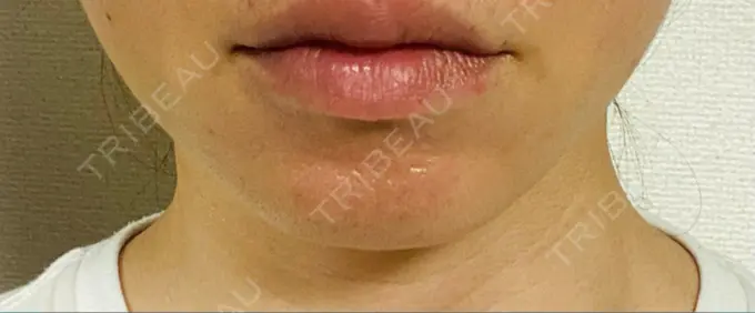 ハイフ（顔） 表参道メディカルクリニック 大阪院 DAY 2 メイン用