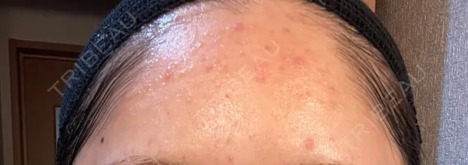 ピーリング（ニキビ・毛穴） / イオン導入 渋谷美容外科クリニック 横浜院 DAY 1 メイン用