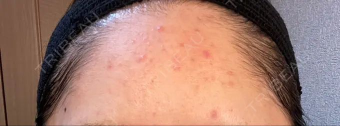 ピーリング（ニキビ・毛穴） / イオン導入 渋谷美容外科クリニック 横浜院 DAY 3 メイン用