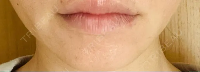 ハイフ（顔） 表参道メディカルクリニック 大阪院 DAY 3 メイン用