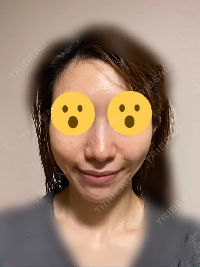 メーラーファット除去 ガーデンクリニック 名古屋院 AFTER メイン用