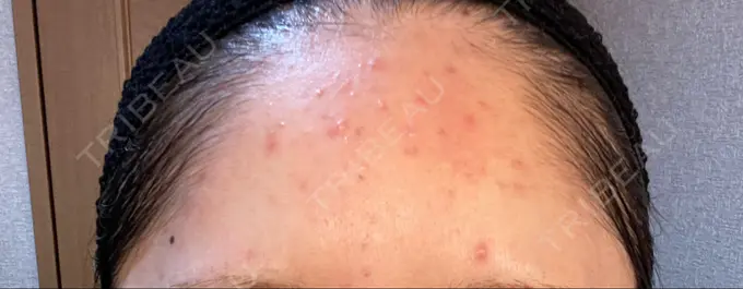 ピーリング（ニキビ・毛穴） / イオン導入 渋谷美容外科クリニック 横浜院 DAY 5 メイン用