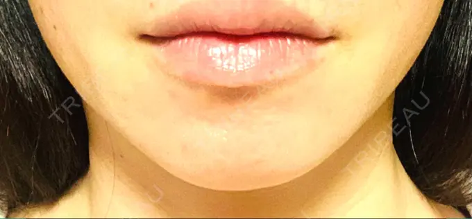 ハイフ（顔） 表参道メディカルクリニック 大阪院 DAY 4 メイン用