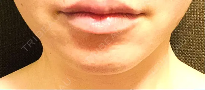 ハイフ（顔） 表参道メディカルクリニック 大阪院 AFTER メイン用