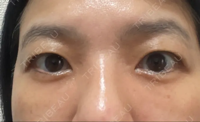 クマ治療 / 下まぶたたるみ取り セオリークリニック AFTER メイン用