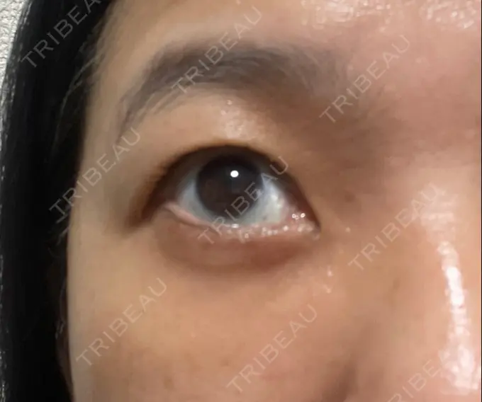 クマ治療 / 下まぶたたるみ取り セオリークリニック DAY 91 メイン用