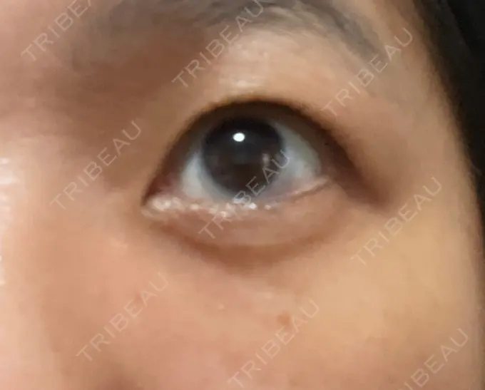 クマ治療 / 下まぶたたるみ取り セオリークリニック DAY 91 メイン用